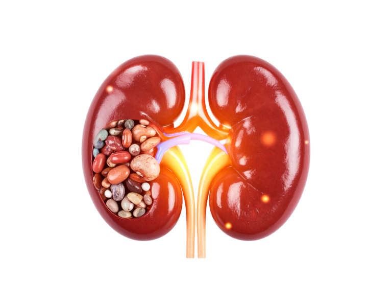 Kidney Stone Symptoms